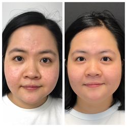 St. Louis Skin Solutions - Before & After 3 LaseMDs