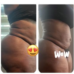 Keyes To Your Heart - Body transformation after just 1 treatment of lymphatic drainage massage and wood therapy!