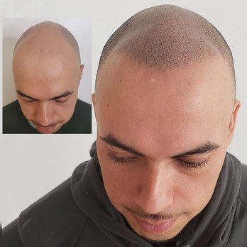 Hair Tattoo Austin Round Rock Micro Scalp Pigmentation Yelp