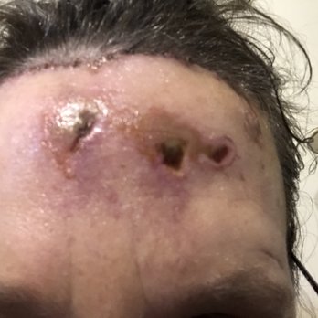 Novus Clinic - Surgical site blisters. - Ophthalmologists Near Me - Tallmadge, Ohio Novus Clinic - Surgical site blisters. - Ophthalmologists Near Me - Tallmadge, Ohio