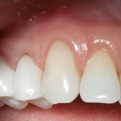 John U Choi, DDS, PhD - (Case 2) Soft tissue recontouring of upper right canine and lateral: Solved problem with a connective tissue graft to reshape teeth and gums