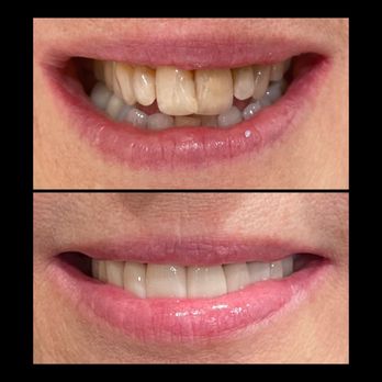 Bridgeport Aesthetic Dentistry - This is my NEW SMILE! - General Dentistry Near Me - Valencia, California