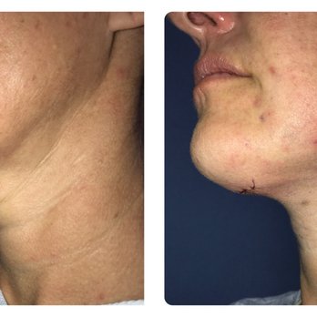 Thomas W. Barnes, MD - Pre op and immediate post op - Cosmetic Surgeons Near Me - Newport Beach, California