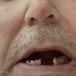 JJ Dental - My bf's missing implant zirconia caps