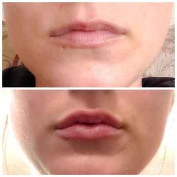 Flawless Med Spa - Before and After using Restylane Lyft - Skin Care Near Me - La Verne, California