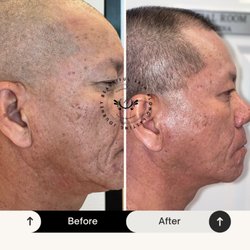 Bio-Micro-needling