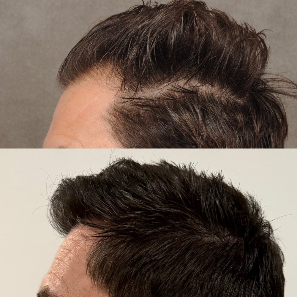 Beverly Hills Hair Group — hair transplant clinic in Beverly Hills, CA