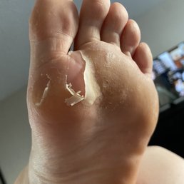 The callus left over after my "callus removal" service, which of course I paid extra for.  Horrendous.