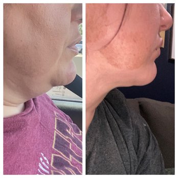 Dev Wali, MD Plastic Surgery-Medspa - Day of surgery (left). 90 days post op (right). - Cosmetic Surgeons Near Me - Claremont, California