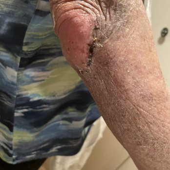 Premiere Plastic Surgery - after 2 days ! amazing. - Cosmetic Surgeons Near Me - Pasadena, California Premiere Plastic Surgery - after 2 days ! amazing. - Cosmetic Surgeons Near Me - Pasadena, California