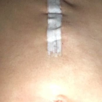 Mehrizi Nasser, MD - This is from Day 1 after he took off the dressing and now the last picture is actually worse in person - Surgeons Near Me - Paramount, California Mehrizi Nasser, MD - This is from Day 1 after he took off the dressing and now the last picture is actually worse in person - Surgeons Near Me - Paramount, California