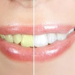 Larry F. James, DDS - Teeth whitening