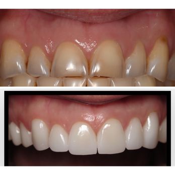 Karin Hatami, DDS - Veneers before and after - Cosmetic Dentists Near Me - Redlands, California