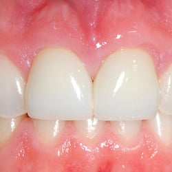 Concord Oral Surgery & Dental Implant Specialists - These two beautiful prosthetic crowns are supported by titanium-free CeraRoot all white dental implants