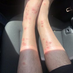 StayInn - Bed bug bites