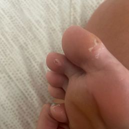 They gave me athletes foot