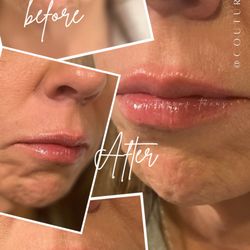 That Couture Look - Juvederm Lip Filler