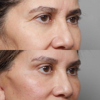 Daniel J Gould, MD PhD - Cosmetic surgery before and after. - Plastic Surgeons Near Me - Beverly Hills, California