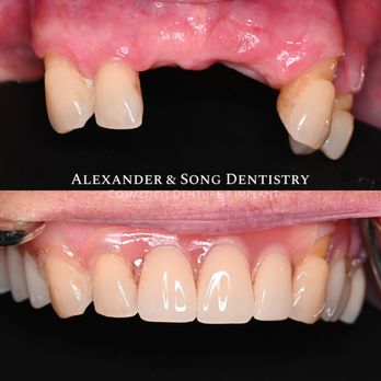 Alexander & Song Dentistry - Need a new partial denture? - Cosmetic Dentists Near Me - Carrollton, Texas Alexander & Song Dentistry - Need a new partial denture? - Cosmetic Dentists Near Me - Carrollton, Texas