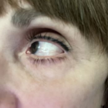 American Surgical Arts - Notice the outer corners of my eyelids . They are not flush with my eyeballs. This is a botched result - Cosmetic Surgeons Near Me - Vineland, New Jersey American Surgical Arts - Notice the outer corners of my eyelids . They are not flush with my eyeballs. This is a botched result - Cosmetic Surgeons Near Me - Vineland, New Jersey
