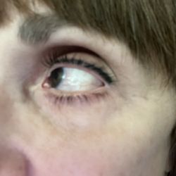 American Surgical Arts - Notice the outer corners of my eyelids . They are not flush with my eyeballs. This is a botched result