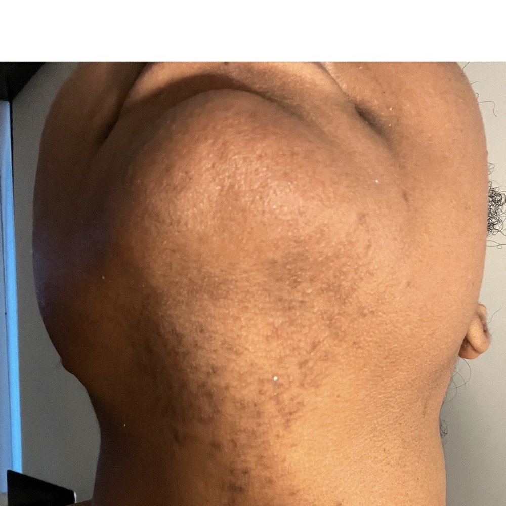 LaserAway - May 6, 2022 - Medical Spas Near Me - Chicago, Illinois
