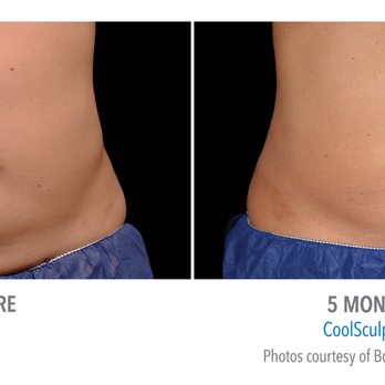 Aloha Nani Kino Spa - Coolsculpting on abdomen - Medical Spas Near Me Aloha Nani Kino Spa - Coolsculpting on abdomen - Medical Spas Near Me