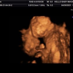 Ultrasound