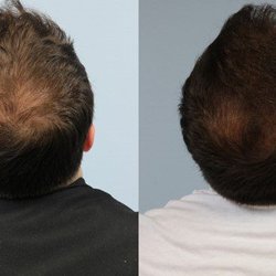Impressions MedSpa - Hair restoration for men