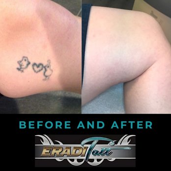 EradiTatt - Tattoo Removal Near Me - Tampa, Florida EradiTatt - Tattoo Removal Near Me - Tampa, Florida