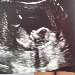 Babyview 3D/4D Ultrasounds