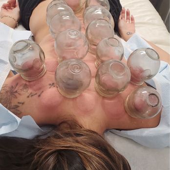 Northridge Acupuncture - Acupuncture Near Me - Reseda, California