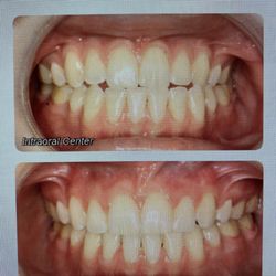 Hohl Orthodontics - Before and after braces.