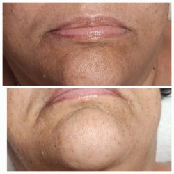 Surf City Skin Care - Microdermabrasion Facial only one treatment with Yon-Ka products.