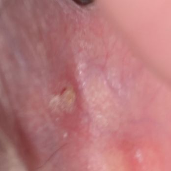 Couture Medical - Keratosis..treated by kate pham..worse rhan before she froze it. - Dermatologists Near Me - Las Vegas, Nevada Couture Medical - Keratosis..treated by kate pham..worse rhan before she froze it. - Dermatologists Near Me - Las Vegas, Nevada
