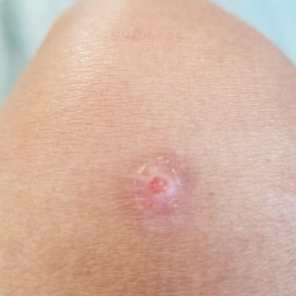 AllSkin Dermatology - after 2nd home treatment - Dermatologists Near Me - Berkeley, California