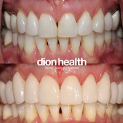 Dion Health - porcelain veneers