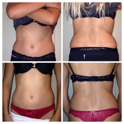 Smooth Silhouette - Before & after 2 treatments cavitation /Endermologie