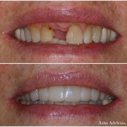 Anaheim Hills Smile Studio - Before and After Snap-On Smile Appliance.