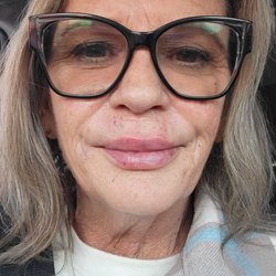 After photo with a very natural even lift and way less wrinkles. So much happier