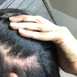 Sore on my scalp Sore on my scalp