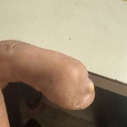 Galaria Plastic Surgery & Dermatology - This is my finger look at my after. Operation removing my nail for second time. He claim he's the best doctor.
