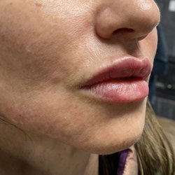 Integrative Wellness and Aesthetics  - Lip filler
