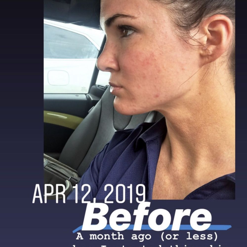 Skin & Sugar - Before - Skin Care Near Me - Upper Arlington, Ohio Skin & Sugar - Before - Skin Care Near Me - Upper Arlington, Ohio