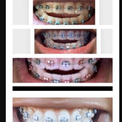 Brite Dental - Trusting the process, open bite getting closed