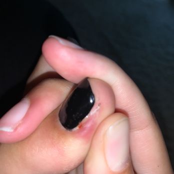 V-Tech Nails and Spa - Toe damage - Nail Salons Near Me - Fresno, California
