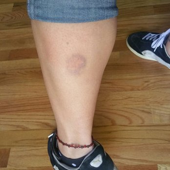 Grease Monkey - Bruise I received from their broken front door - Auto Repair Near Me - Lakewood, Colorado