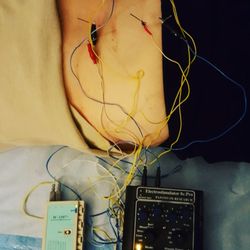 Atlantic Center for Acupuncture - Electro-acupuncture provides neurotransmitters to reduce pain and heal injury