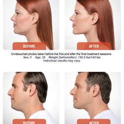 Balle David S MD - Dr. Balle offers Kybella for Submental fullness under the chin