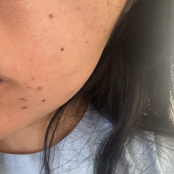 Slick Threading & Waxing Salon - So many cuts all over the face from the wax. - Threading Services Near Me - Corona, California